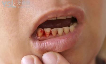 戒烟后为什么牙龈容易出血 ，戒烟为什么牙龈会肿
